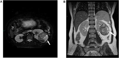 Case Report: Retroperitoneal Laparoscopic Partial Nephrectomy for T2 Renal Cell Carcinoma During Pregnancy